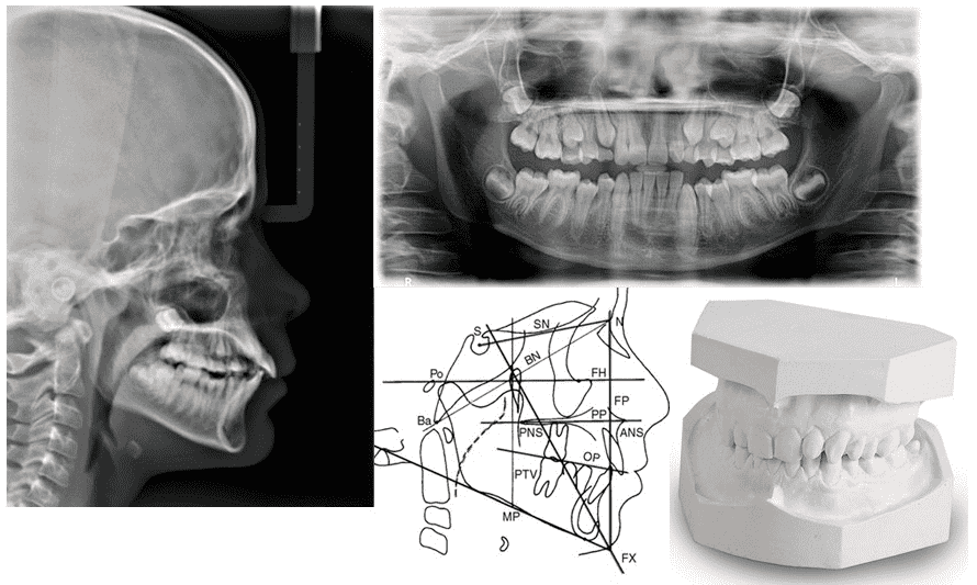 El estudio de ortodoncia, en qué consiste