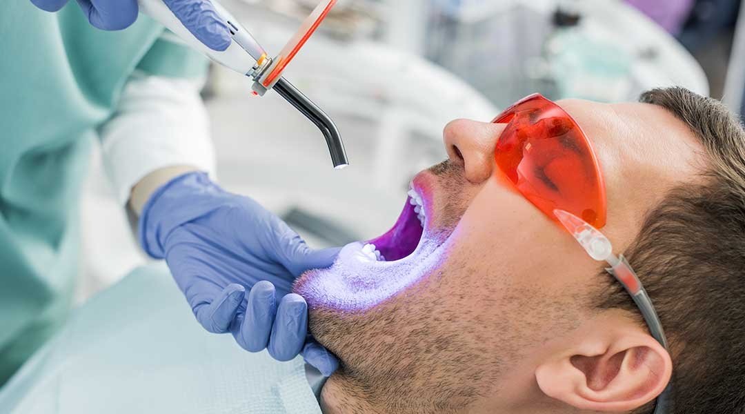Recomendaciones sobre blanqueamientos dentales